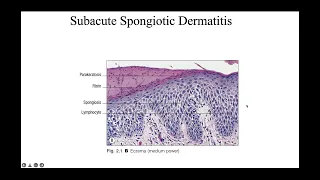 Spongiotic reaction patterns.