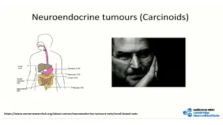 Oxford University surgical lectures: Small intestinal neuroendocrine tumours