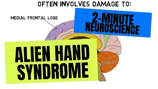 2-Minute Neuroscience: Alien Hand Syndrome