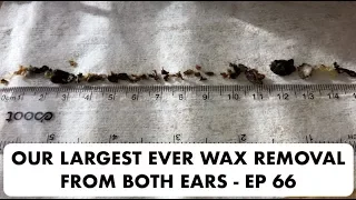 OUR LARGEST EVER EAR WAX REMOVAL FROM BOTH EARS - EP 66