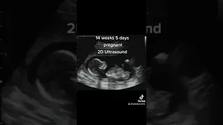 2D Pregnancy Ultrasound at 14 Weeks 5 Days