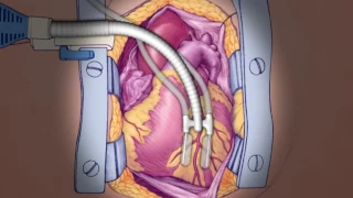 Off-Pump Bypass Animation