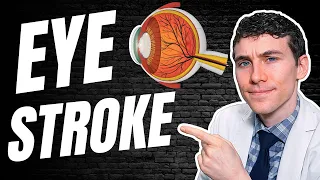 EYE STROKE - Retinal Vein Occlusion (Causes, Symptoms, Treatment)