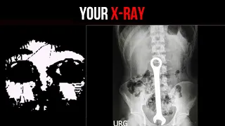 Mr Incredible Becoming Uncanny (X-ray)