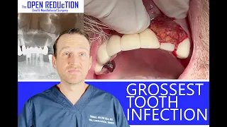 The GROSSEST TOOTH INFECTION You'll EVER SEE