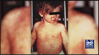 Doctors are urging the public to get measles vaccines after recent outbreaks