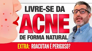 ACNE: como tratar as espinhas naturalmente 👉 🔴 👈