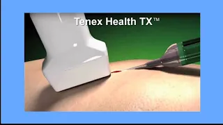 Animation - Tenex Health TX treats chronic tendonitis and plantar fasciitis pain