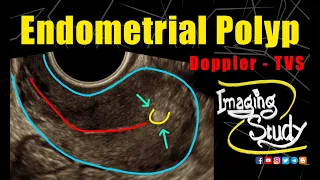 Endometrial Polyp || Ultrasound || TVS || Case 290