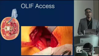 Oblique Complications & Avoidance Techniques: A Case Review by Kamal Woods, MD