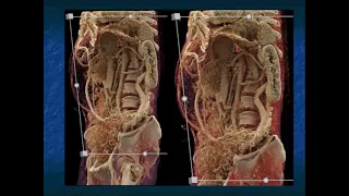 Gastric GIST Tumors: Pearls and Pitfalls - Part 3