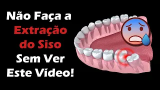 Extração de Siso – 3 Coisas Para Fazer Que Deixam a Cirurgia Mais Tranquila