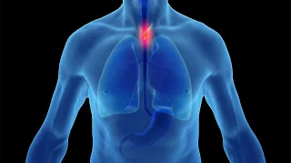 Heartburn, Reflux and GERD: Preventing the Progression to Esophageal Cancer