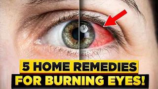 Burning Eyes: 5 Causes & 5 Reliable Home Remedies For Burning Eyes