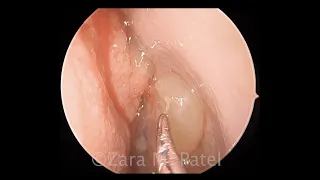 Endoscopic Sinus Surgery for Chronic Rhinosinusitis with Nasal Polyps (CRSwNP)