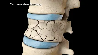 vertebroplasty and kyphoplasty