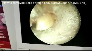 HOW TO REMOVE  SOLID EAR FOREIGN BODY (DR.JEGO ORI)