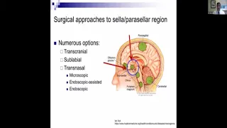 Pituitary Tumors: What You Need to Know about Surgery Webinar