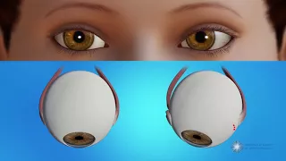 How is strabismus surgery done?