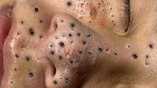 Loan Nguyen Acne spa #566