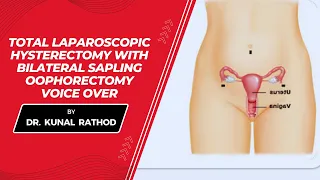 Total laparoscopic hysterectomy with bilateral sapling oophorectomy voice over | Dr Kunal Rathod