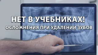 Нет в учебниках! Осложнения при удалении зубов!