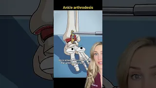 Doctor explains: ankle fusion surgery