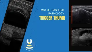 Trigger thumb on ultrasound