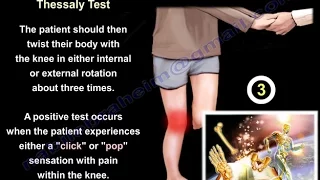 Meniscal Tears Examination & Tests - Everything You Need To Know - Dr. Nabil Ebraheim