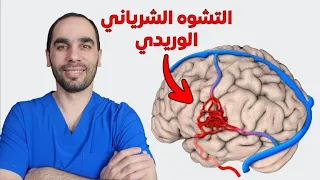 التشوه الشرياني الوريدي AVM: أسبابه وعلاجاته الجديدة