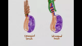 Testicular Torsion