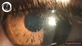 Adenoviral punctate keratitis