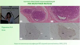 Папиллярные опухоли молочной железы