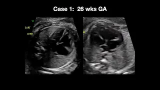2023 Fetal Echocardiography: Normal and Abnormal Hearts - A Video CME Teaching Activity