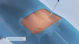 Intracept Procedure 3D Animation - Reno, Nevada