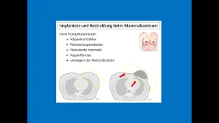 Implantate und Bestrahlung beim Mammakarzinom | Strahlentherapie Prof. Hilke Vorwerk