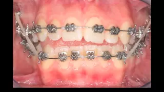 Orthodontic Open bite Movie Collection