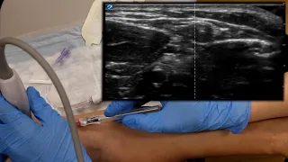 Ultrasound Guided IV Tutorial