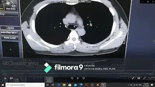 Thoracic CT اشعة مقطعية على الصدر