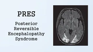 PRES (Posterior Reversible Encephalopathy Syndrome)