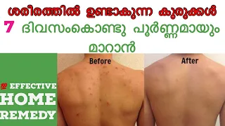 How To Get Rid of Back Acne the Natural Way | Effective Home Remedies||malayalam