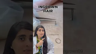 Ingrown Hair Removal | Ingrown Hair Treatment | Ingrown Hair Dermatologist