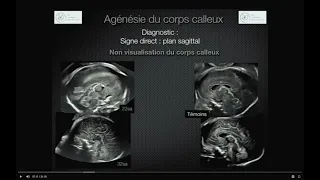 MALFORMATIONS CEREBRALES EN ECHOGRAPHIE OBSTETRICALE