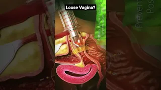 V- Lase For Vaginal Tightening #Shorts