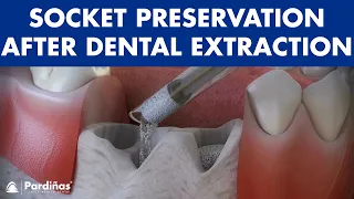 Tooth extraction - Treatment for socket preservation ©