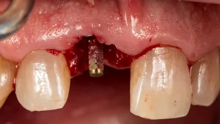 Immediate implant placement and provisional