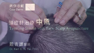 Scalp Acupuncture for Post Stroke 頭皮針中風病例示範  - KarlTai 戴吉雄醫師