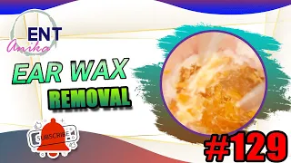 AnikaENT - Ear Wax Removal | Treatment For Eardrum Rupture [Ep#129]