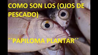 COMO ES EL OJO DE PESCADO, COMO TRATARLO Y PREVENIRLO, (PAPILOMA PLANTAR)