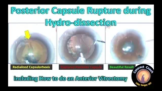 Posterior Capsule Rupture during Hydro-dissection & Anterior Vitrectomy in Cataract Surgery